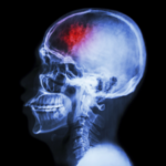 Traumatic Brain Injuries - Kills 153 People Every Day