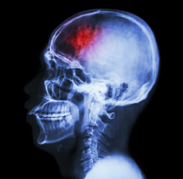 Traumatic Brain Injuries – Kills 153 People Every Day