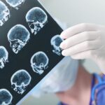 Subdural Hematoma - Symptoms, Causes, & Treatment