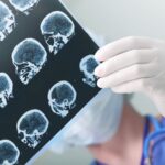 What is a Closed Head Injury?
