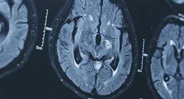 Brian MRI