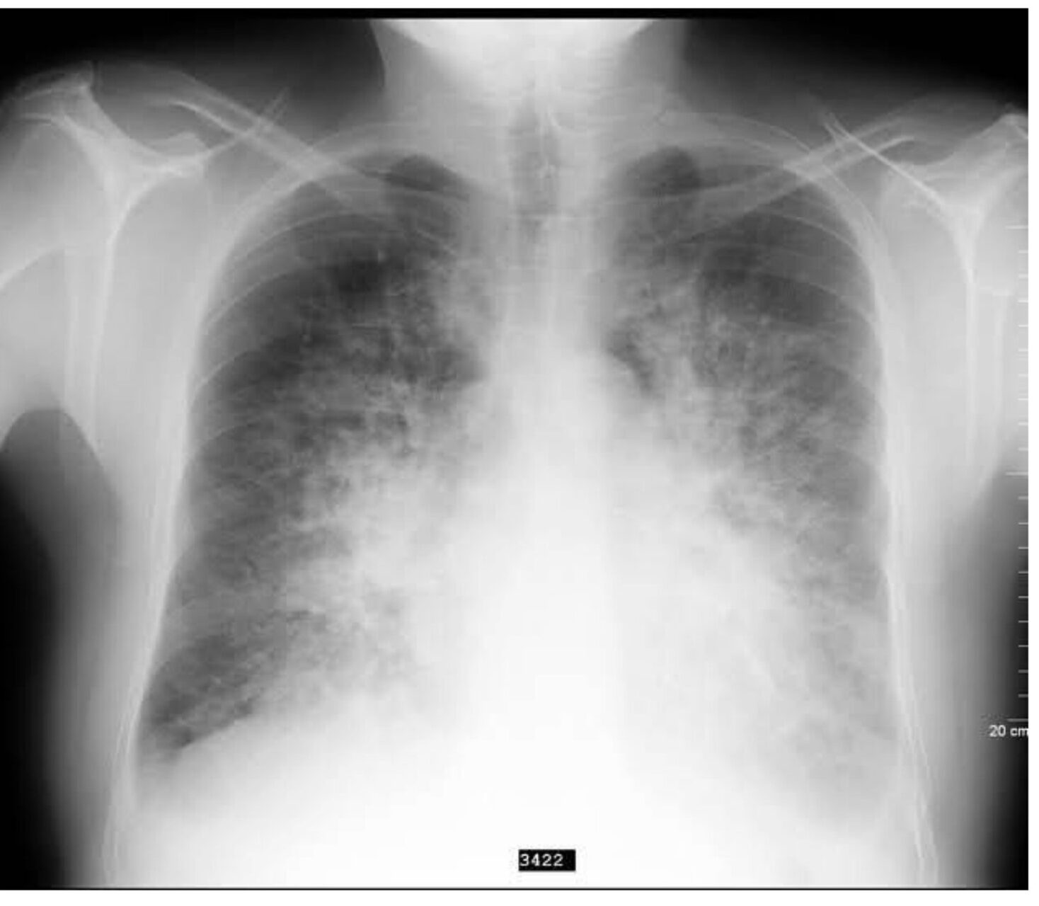 Lung Xray of Pneumonia