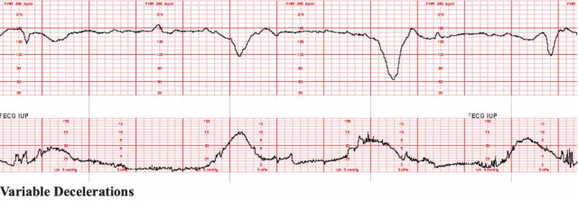 ECG chart