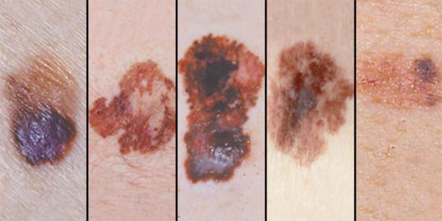 Skin Cancer Images